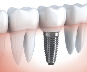 dental-implants-post-image-750x400