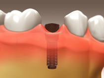 Dental Implants - Scarborough Dentist - Dr. Sara Razmavar - Highland Creek Dental - Illustration 4