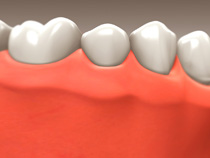 Dental Implants - Scarborough Dentist - Dr. Sara Razmavar - Highland Creek Dental - Illustaration 2
