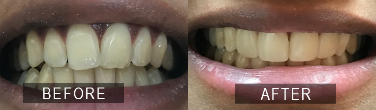 Smile Gallery - Scarborough Dentist - Composite Veneers